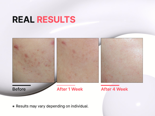 (모바일)스팟알엑스-3_1 نتایج استفاده از کرم ضدلک تیام